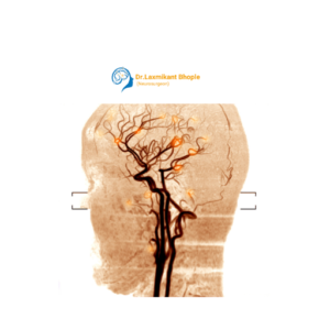 AVM (Arteriovenous Malformation)