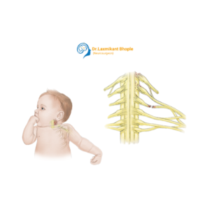 Brachial Plexus Injury