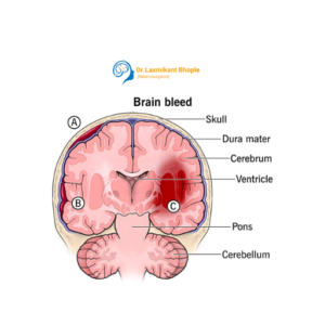 Brain Hemorrhage Management