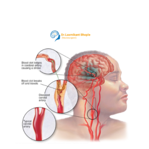 Carotid Artery Disease