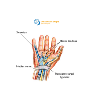 Carpal Tunnel Syndrome