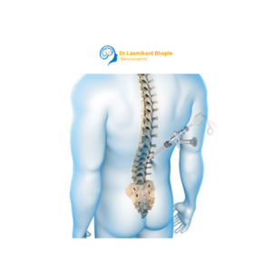 Minimally Invasive Spine Surgery