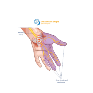 Nerve Compression Syndromes