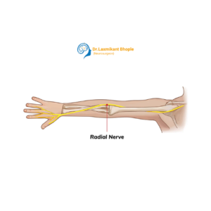 Radial Nerve Palsy