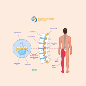 Sciatica & Nerve Compression