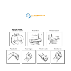 Spasticity Management