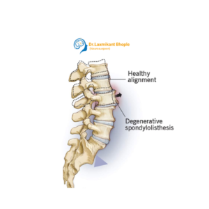 Spondylosis / Degenerative Spine