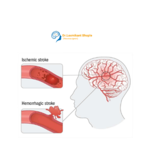 Stroke Emergency Care