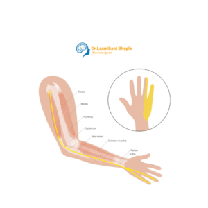 Ulnar Nerve Entrapment