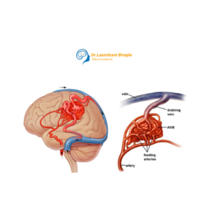 Vascular Malformations